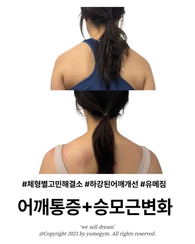 어깨통증+승모근변화