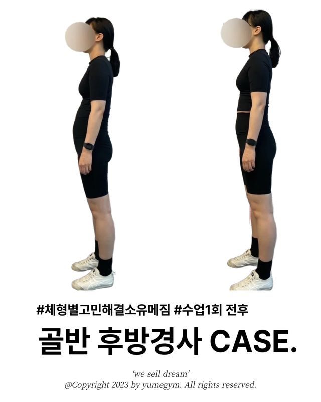 골반 후방경사 CASE